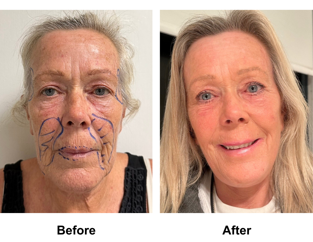 Kathy had MFNL + Fat transfer to Face with Dr. Ring  (1)