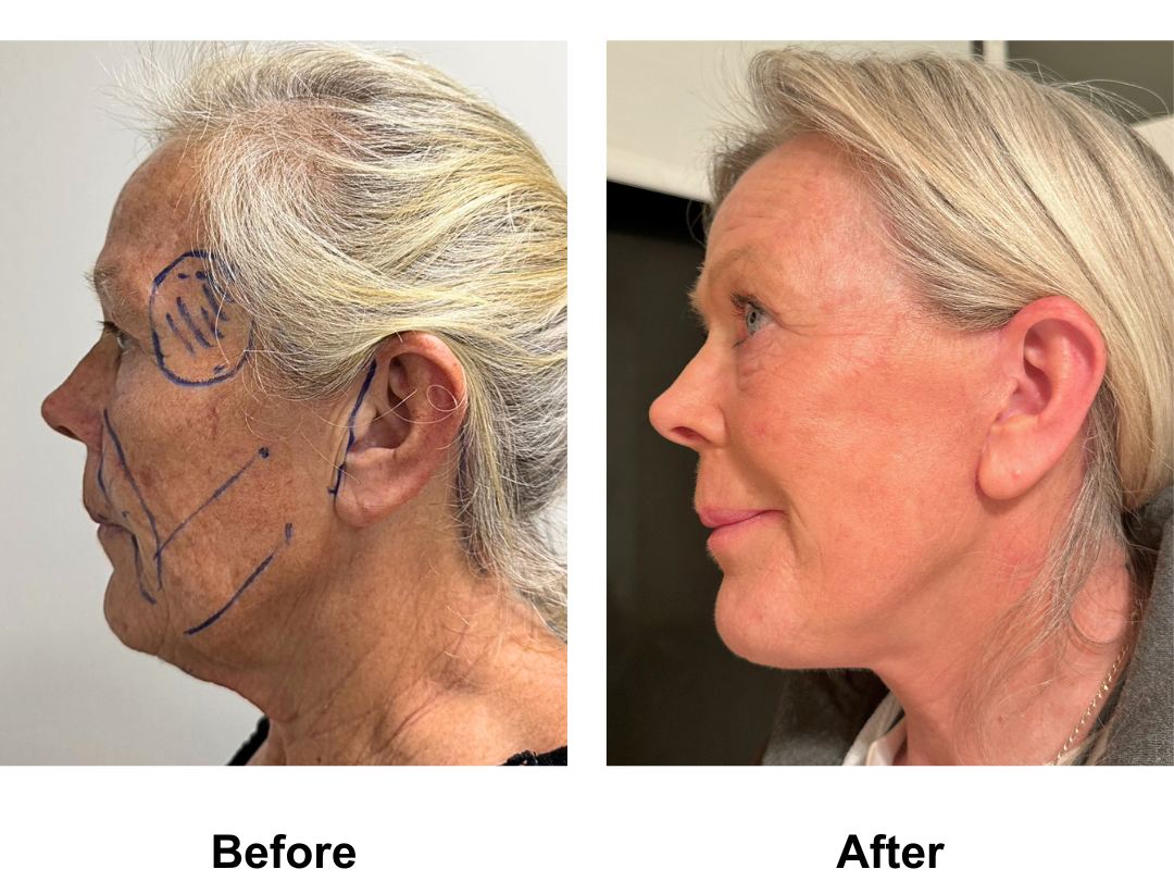Kathy had MFNL + Fat transfer to Face with Dr. Ring