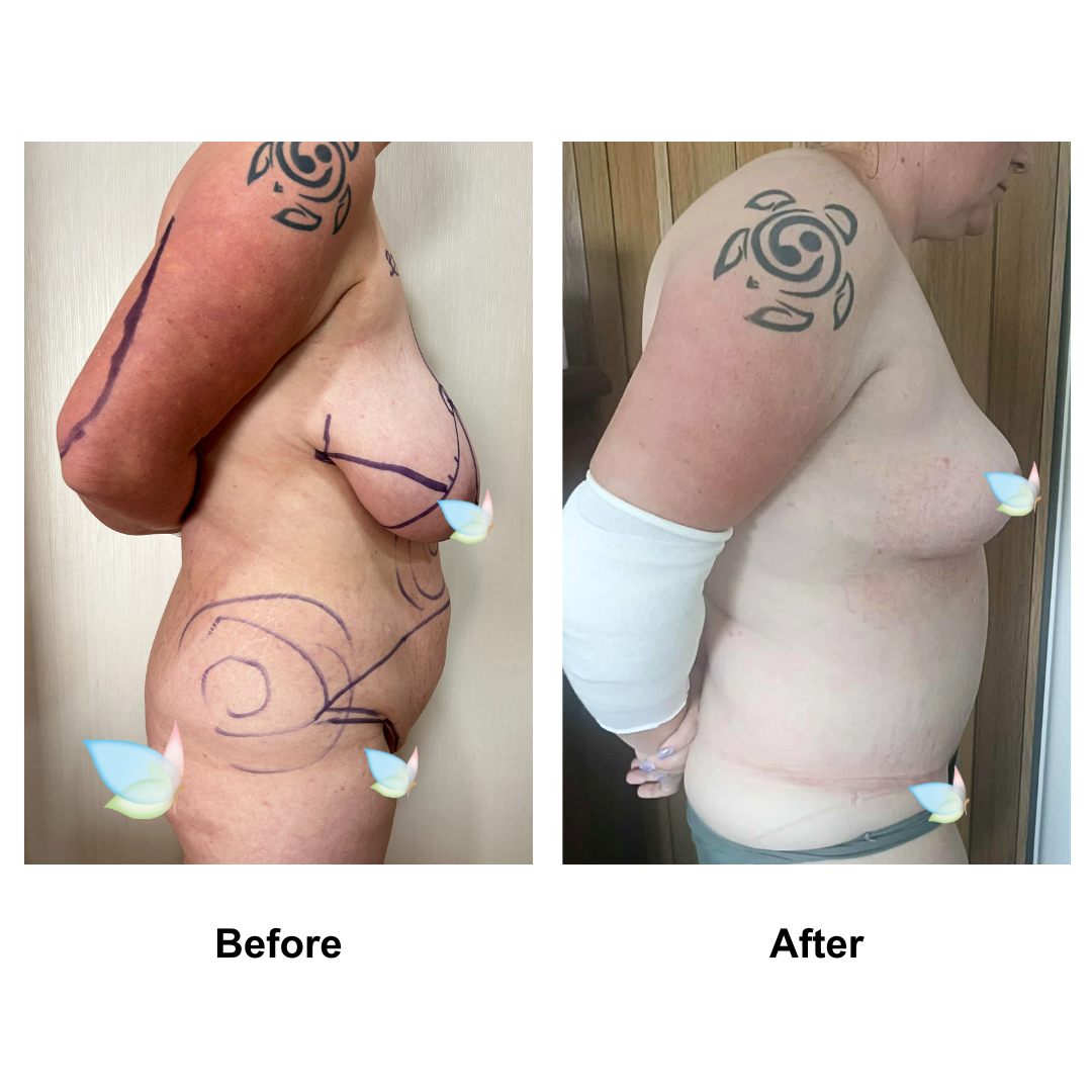 Katie had BR + AL + Ex TT + ML + Lipo_2 with Dr. Angkana (2)