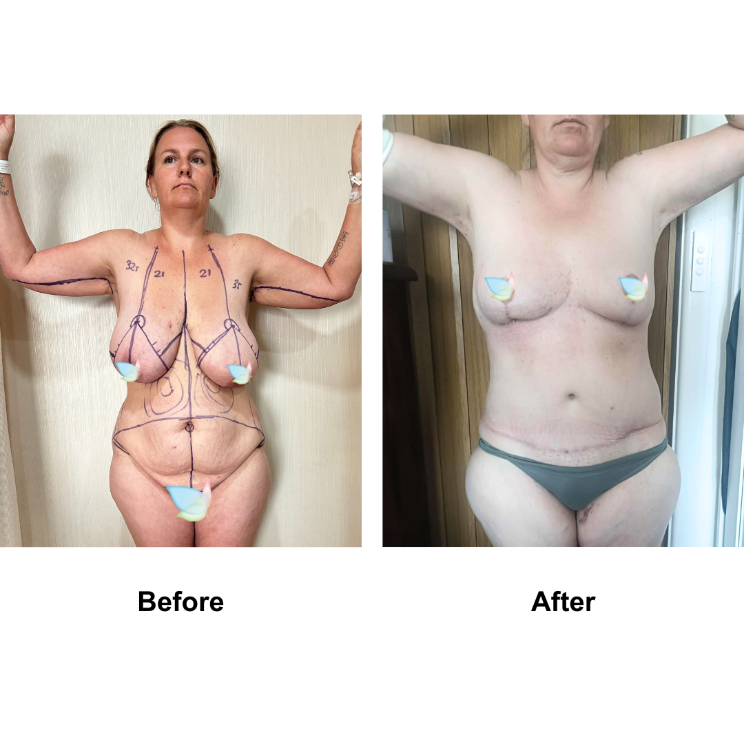Katie had BR + AL + Ex TT + ML + Lipo_2 with Dr. Angkana