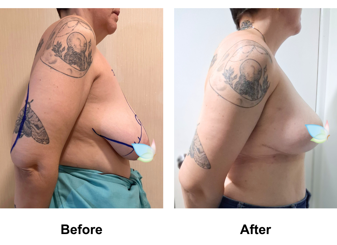 Katie had Massive BR + AL with Dr. Angkana (1)