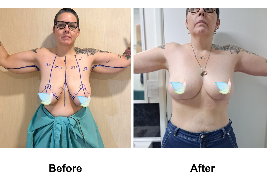 Katie had Massive BR + AL with Dr. Angkana