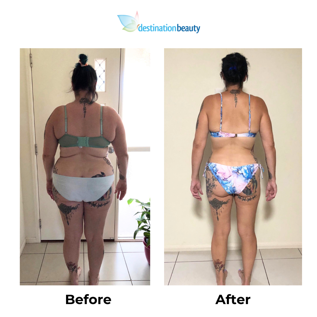 Katie had gastric sleeve surgery in Thailand