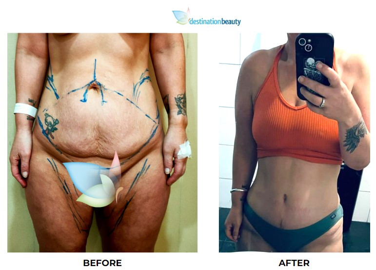 Katrina before after tummy tuck and liposuction