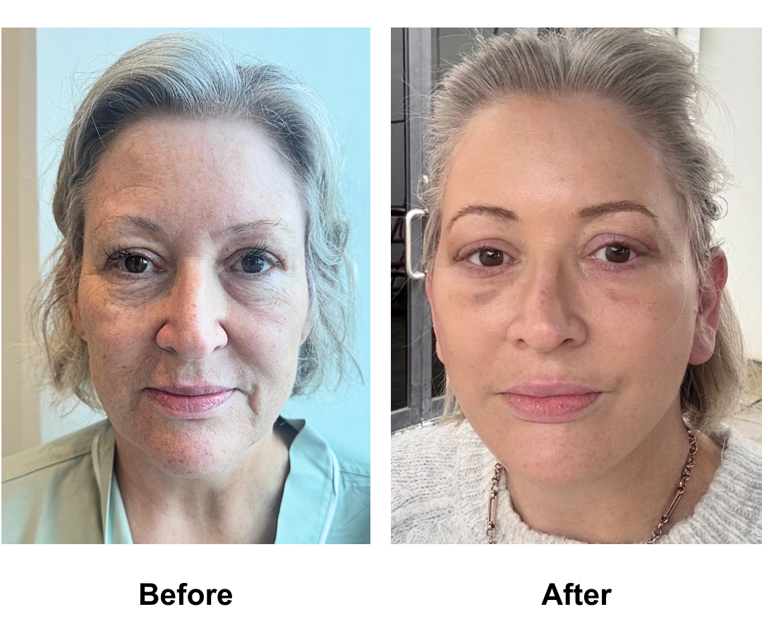 Kelli had MFNL + LB with Dr. NJ