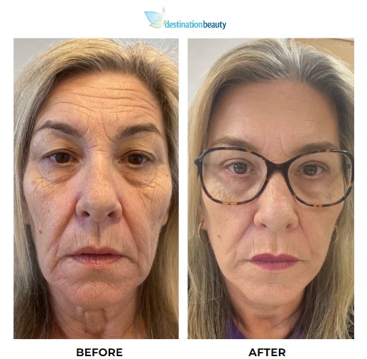 Kellie 7 weeks facelift post op