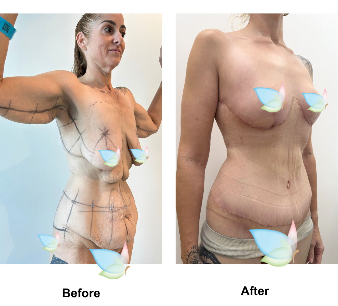 Kellie had Circum TT + Lipo x2 on upper abs, love handle + Mons Lift + BL + SL + AL with Dr. Jatuporn (2)