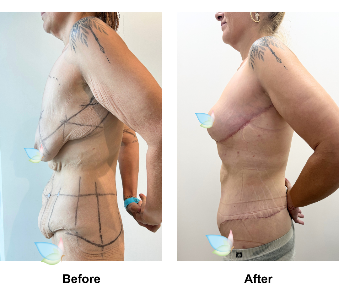 Kellie had Circum TT + Lipo x2 on upper abs, love handle + Mons Lift + BL + SL + AL with Dr. Jatuporn (3)