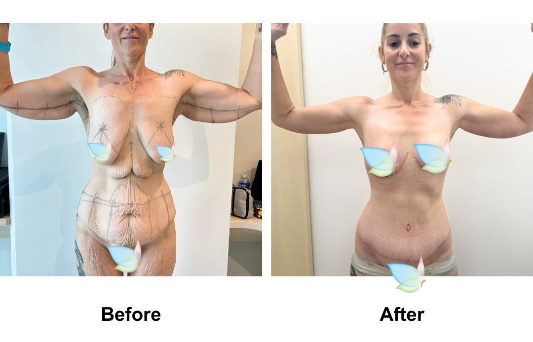 Kellie had Circum TT + Lipo x2 on upper abs, love handle + Mons Lift + BL + SL + AL with Dr. Jatuporn