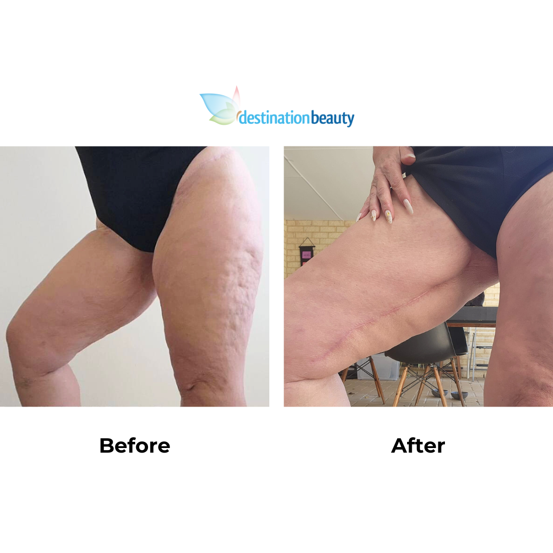 Kelly had thigh lift with Dr. Ring (2)