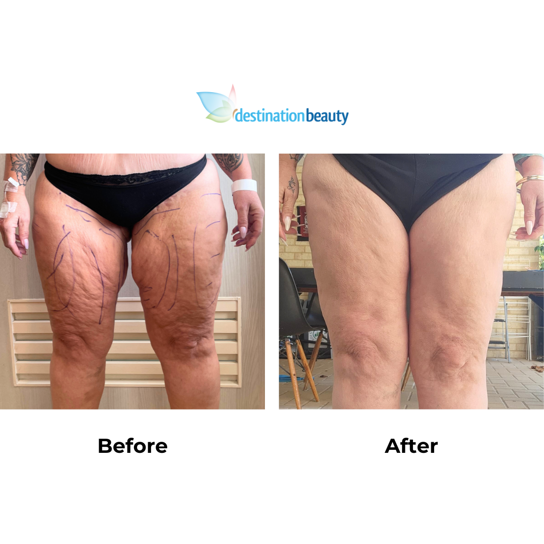 Kelly had thigh lift with Dr. Ring