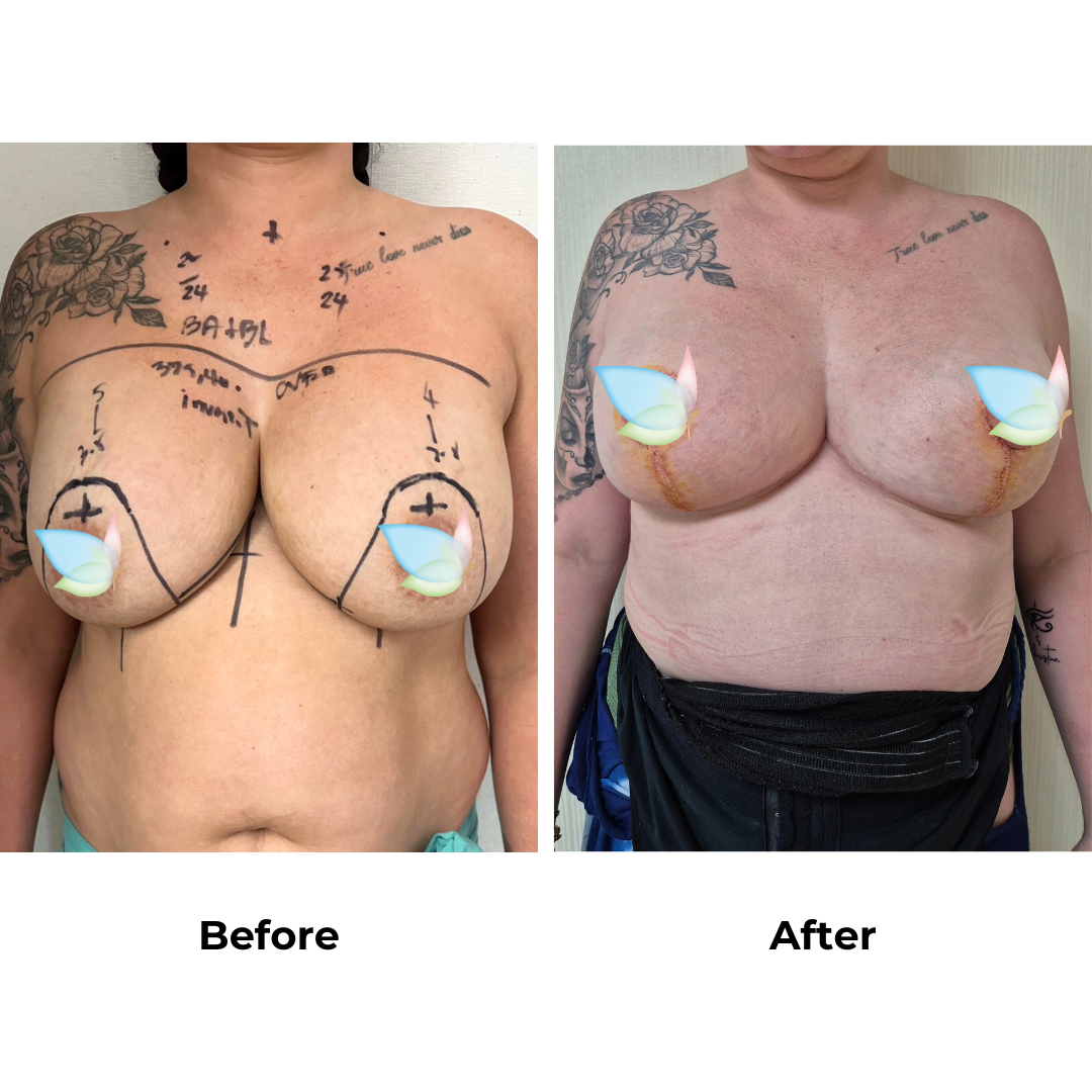 Kellyann had breast revision with Dr. Kasemsak