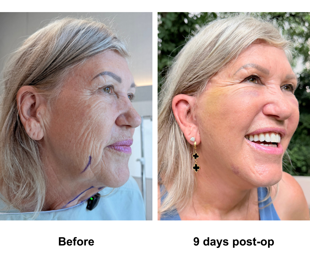 Kerri, 68 had FFNL + Fat transfer to face with Dr. NJ (2)