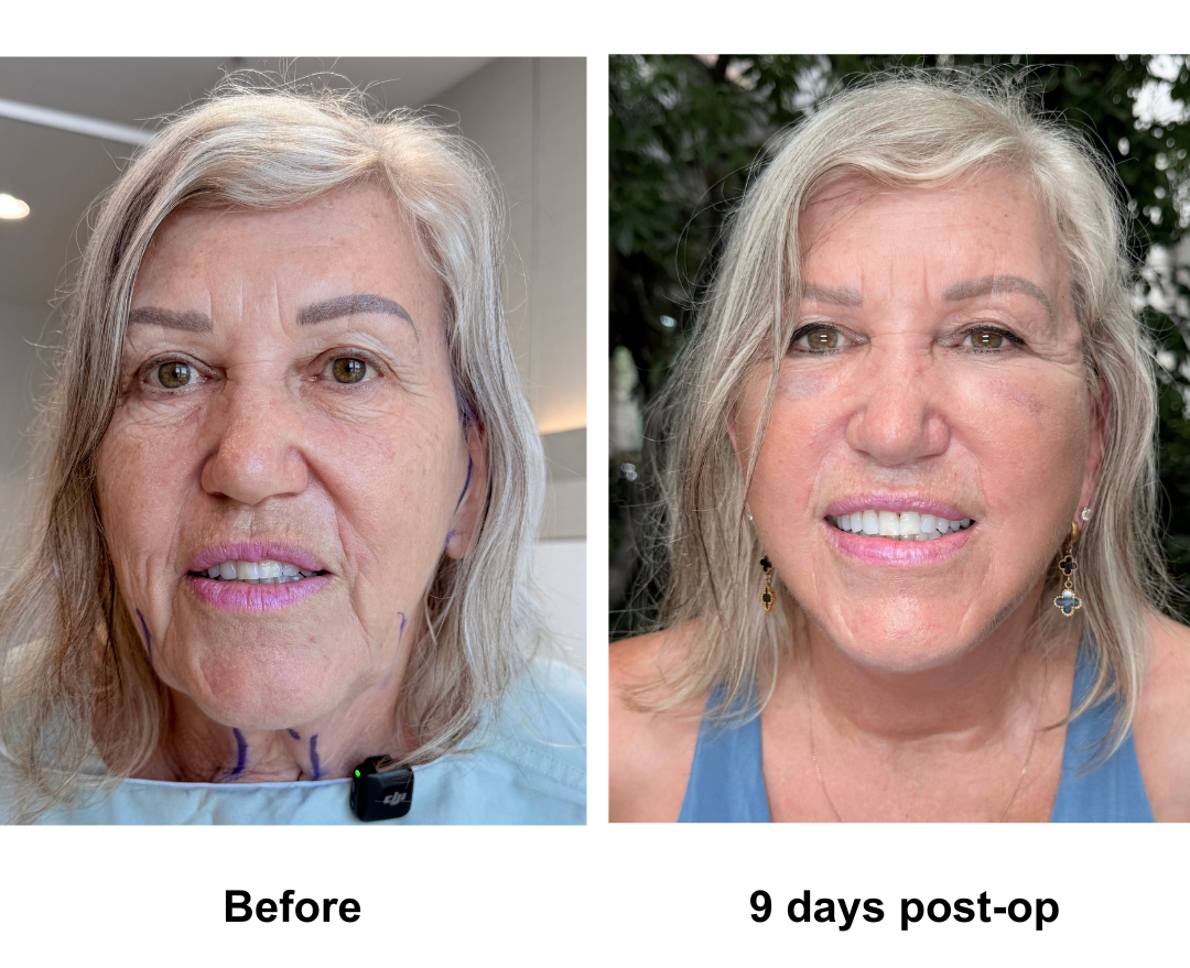 Kerri, 68 had FFNL + Fat transfer to face with Dr. NJ (3)
