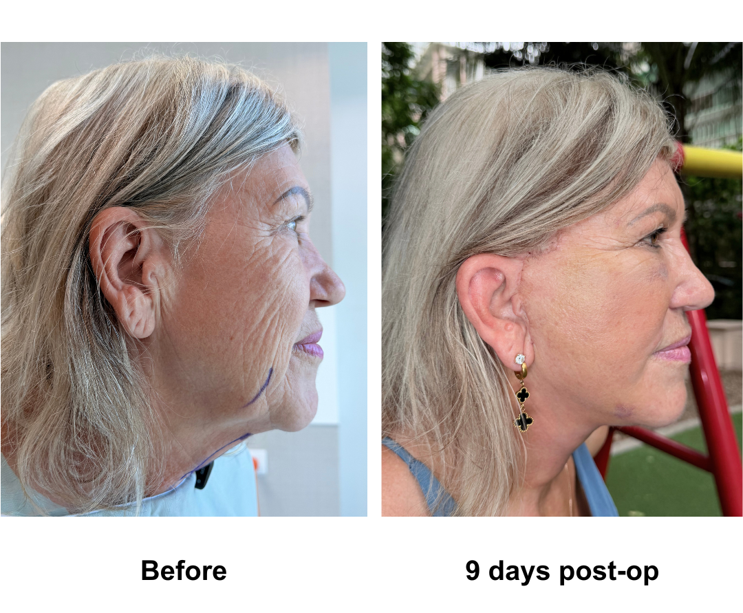Kerri, 68 had FFNL + Fat transfer to face with Dr. NJ (4)