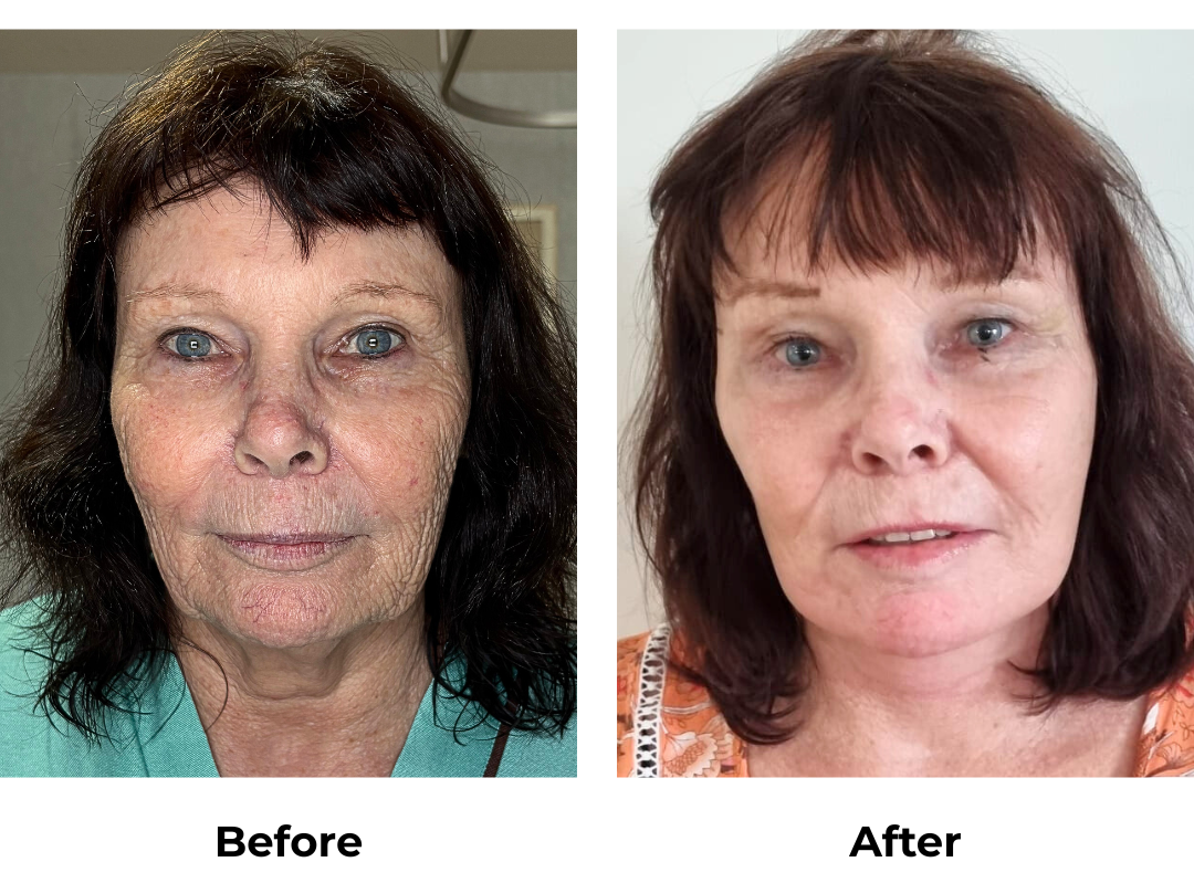 Kerry had FFNL + Chin lift + Endo Brow lift with Dr. Ring (1)