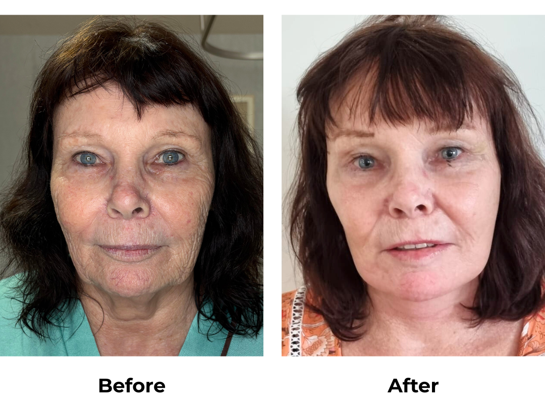 Kerry had FFNL + Chin lift + Endo Brow lift with Dr. Ring (2)