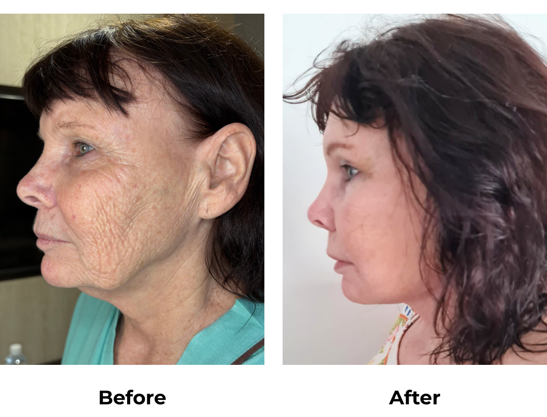 Kerry had FFNL + Chin lift + Endo Brow lift with Dr. Ring