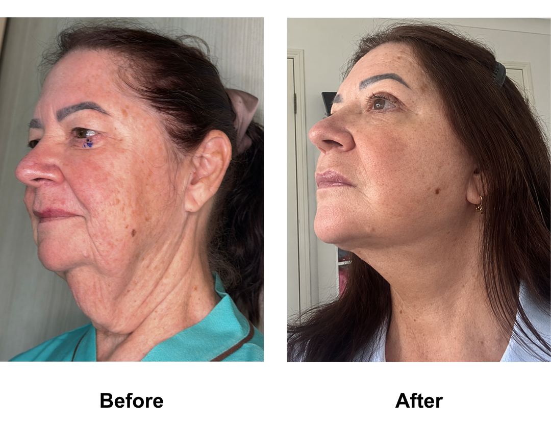 Kerry, 65 had MFNL + Chin lift + ULB with Dr. Ring (1)