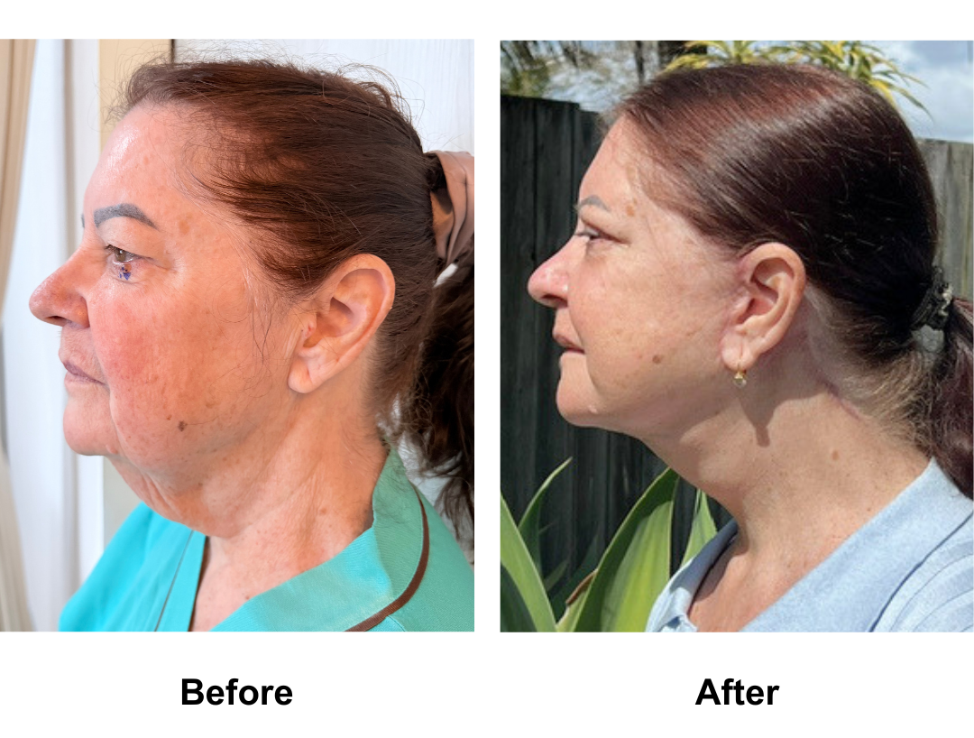 Kerry, 65 had MFNL + Chin lift + ULB with Dr. Ring (2)