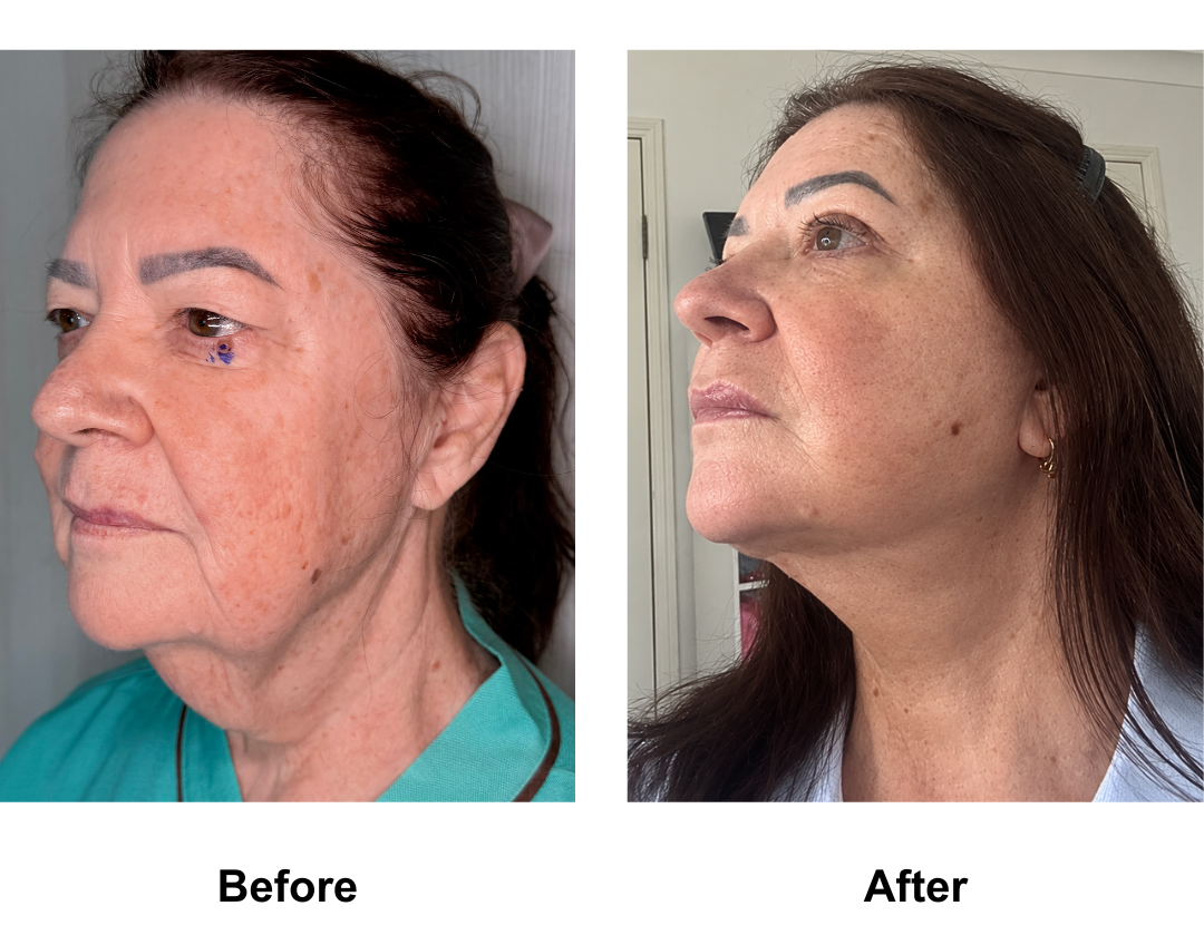 Kerry, 65 had MFNL + Chin lift + ULB with Dr. Ring (3)