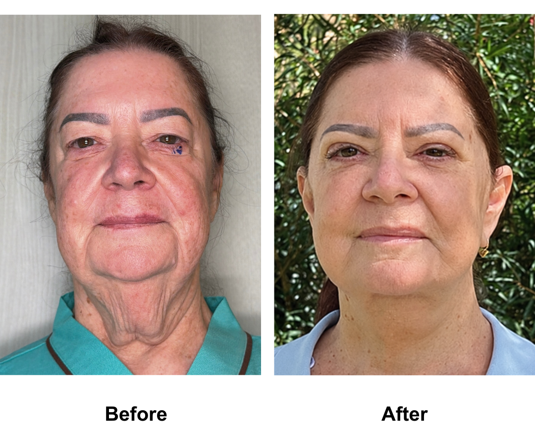 Kerry, 65 had MFNL + Chin lift + ULB with Dr. Ring