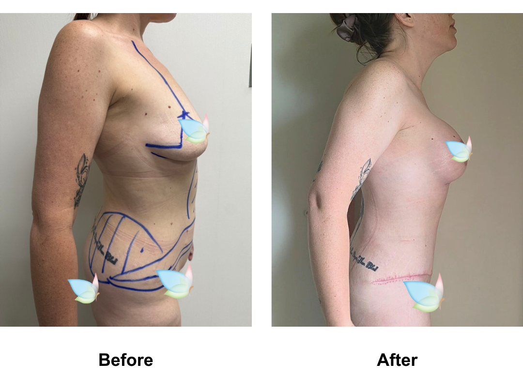 Kia had ExTT + VASER lipo 2 + Mons lift  + BABL (380 demi) with Dr. Ring (3)