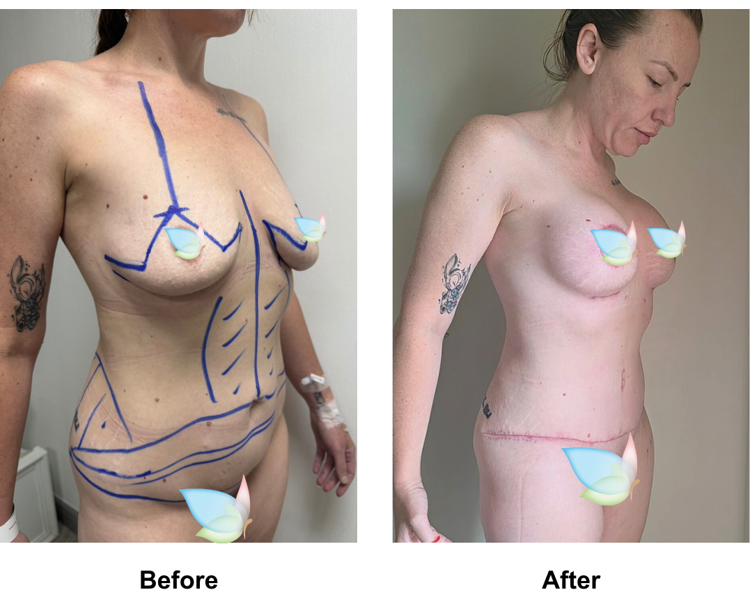 Kia had ExTT + VASER lipo 2 + Mons lift  + BABL (380 demi) with Dr. Ring (4)