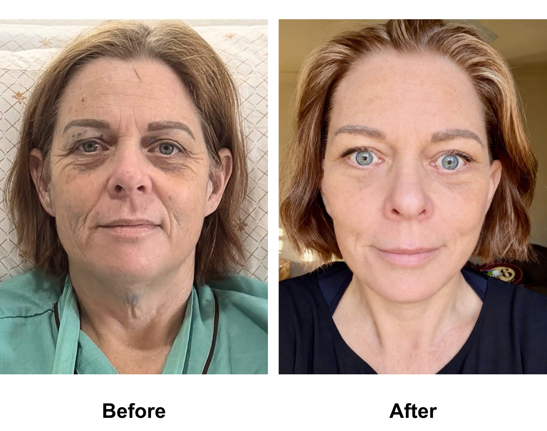 Kim, 46 had FFNL + UB + LB + Chin lift with Ring (2)