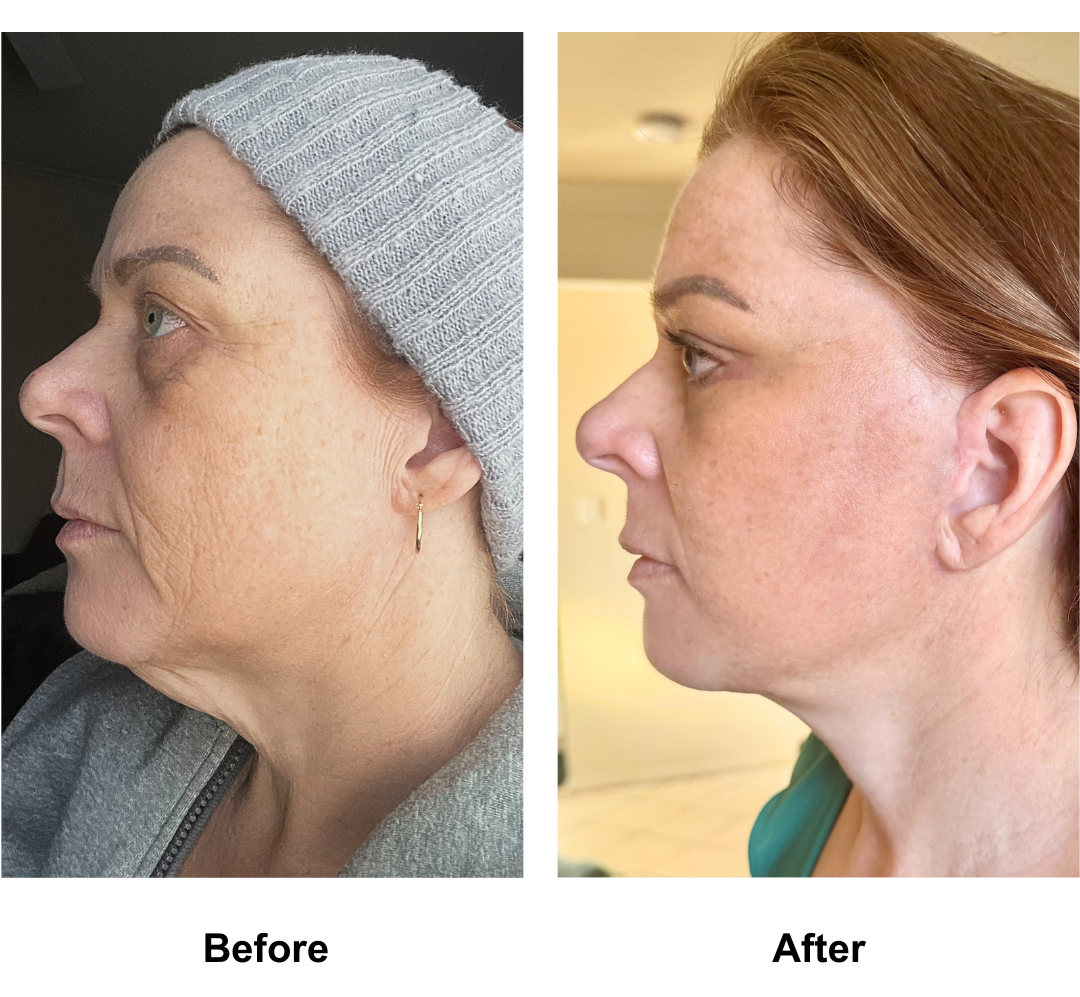 Kim, 46 had FFNL + UB + LB + Chin lift with Ring (3)