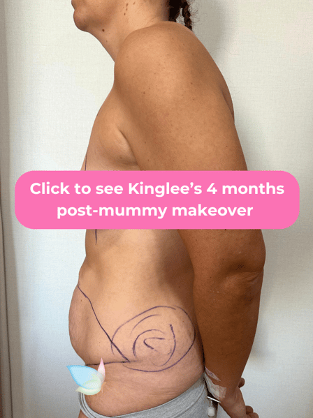 Kingslee had mummy makeover with Dr. Angkana - 4 months PO (2)