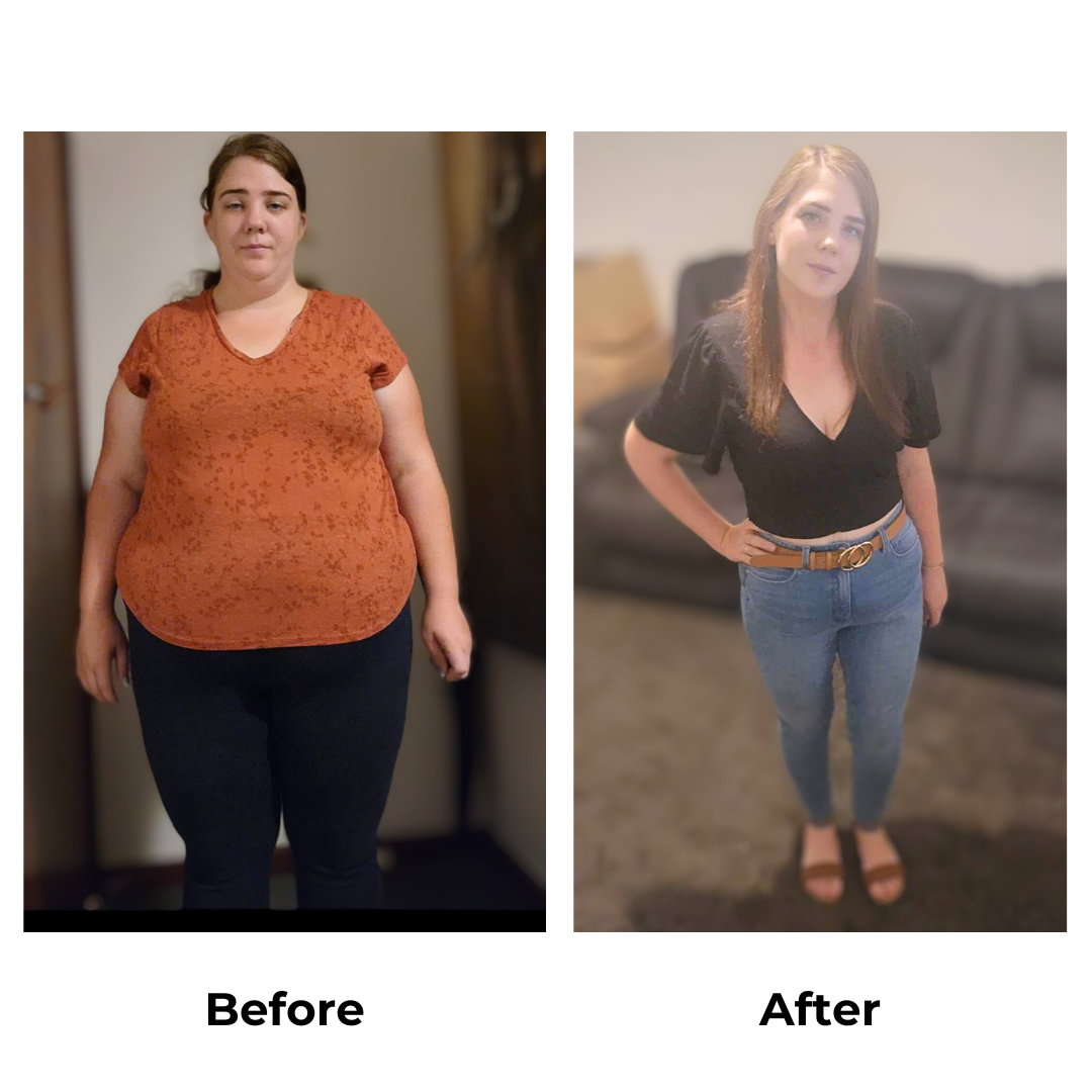 Kirralee before and after gastric sleeve (2)