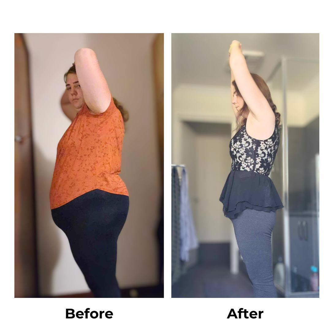 Kirralee before and after gastric sleeve