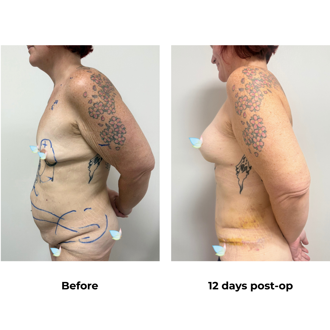 Kirsten had BABL + ExTT + VASER 2 areas + Mons lift with Dr. Kasemsak (3)