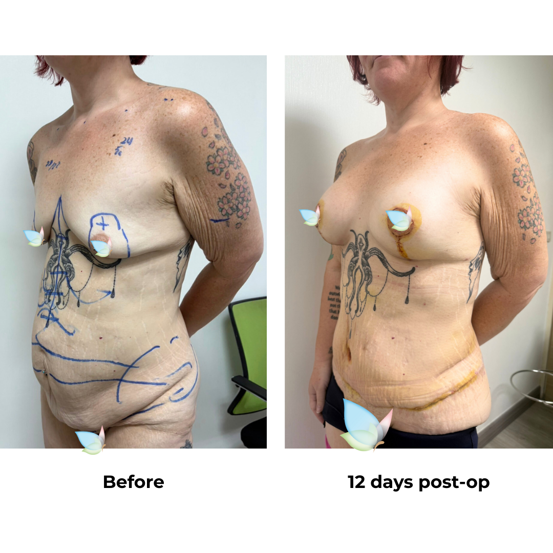 Kirsten had BABL + ExTT + VASER 2 areas + Mons lift with Dr. Kasemsak (4)