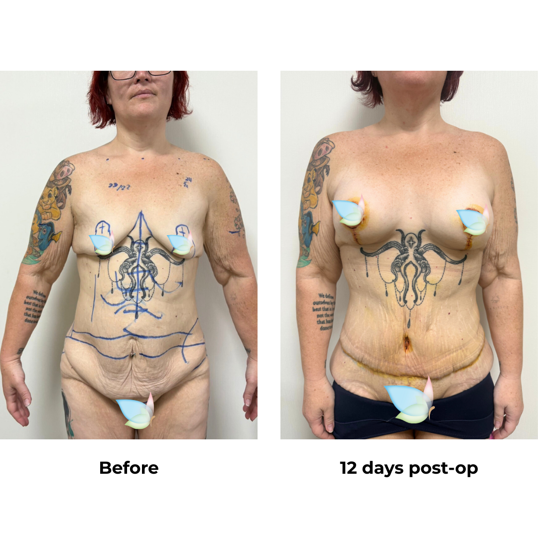 Kirsten had BABL + ExTT + VASER 2 areas + Mons lift with Dr. Kasemsak 1