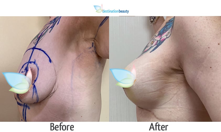 Kirsty breast lift and arm lift