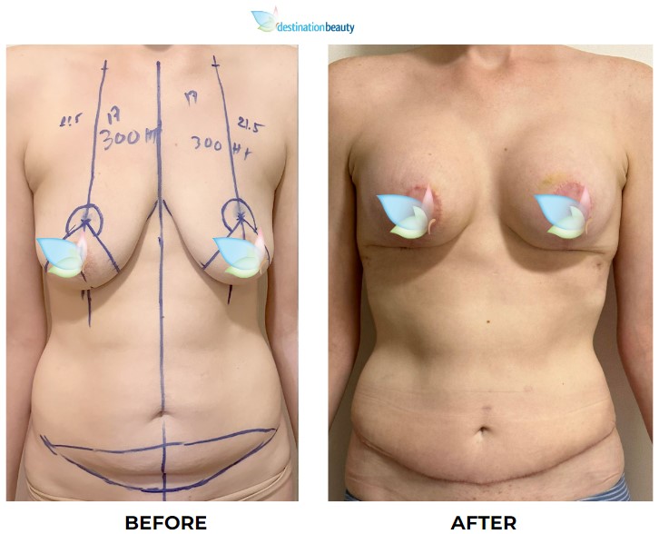 Where Did My Perky Breasts Go? - Keystone Cosmetic Surgery Center