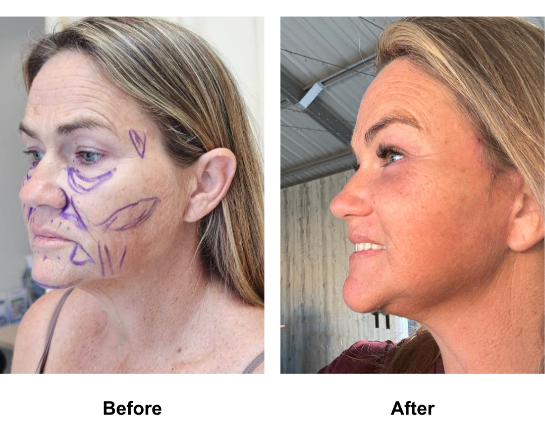 Kristen, 48 had FFNL + Fat transfer to face + LB with Dr. NJ  Endoscopic forehead lift with Dr. Jatuporn (1)