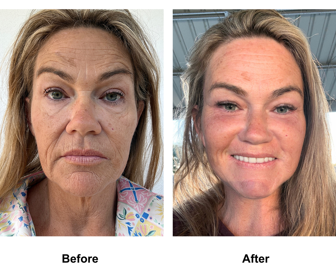 Kristen, 48 had FFNL + Fat transfer to face + LB with Dr. NJ  Endoscopic forehead lift with Dr. Jatuporn