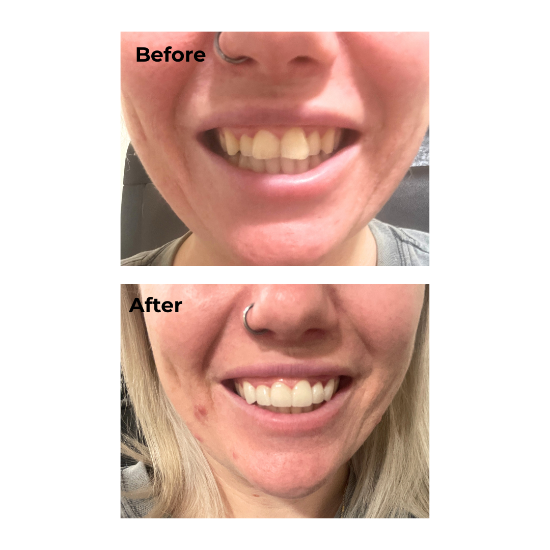 Kristyna had 6 veneers