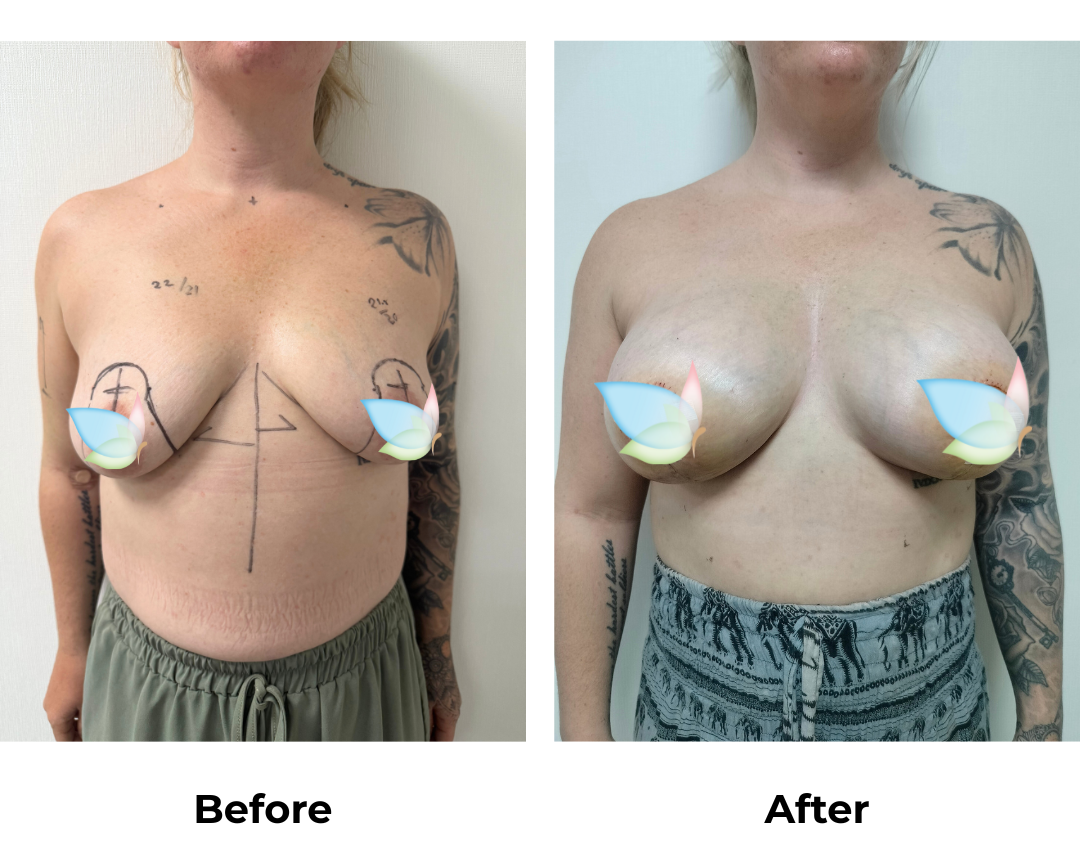 Kristyna had BABL (Motiva 335,355 full) with Dr. Kasemsak (1)