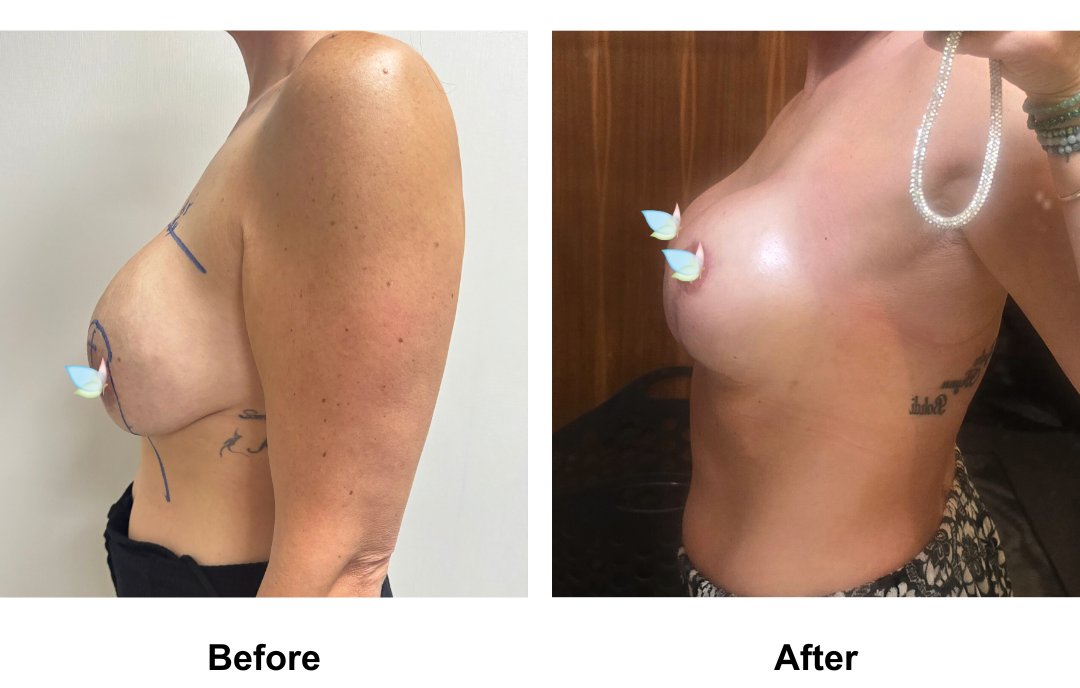 Krystle had Rev. BABL (375 _ 400 Motiva full) with Dr. Kasemsak (2)