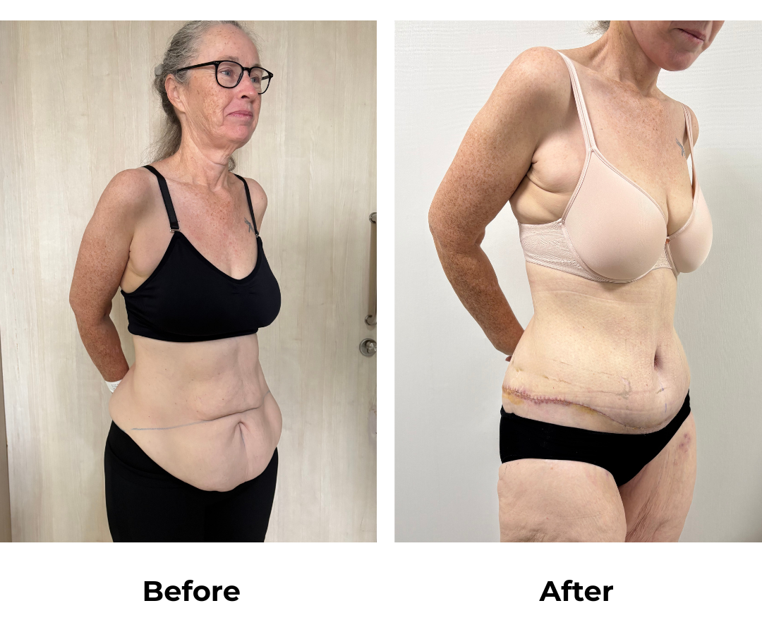 Kylie had Circum TT + Mons Lift with Dr. Ring