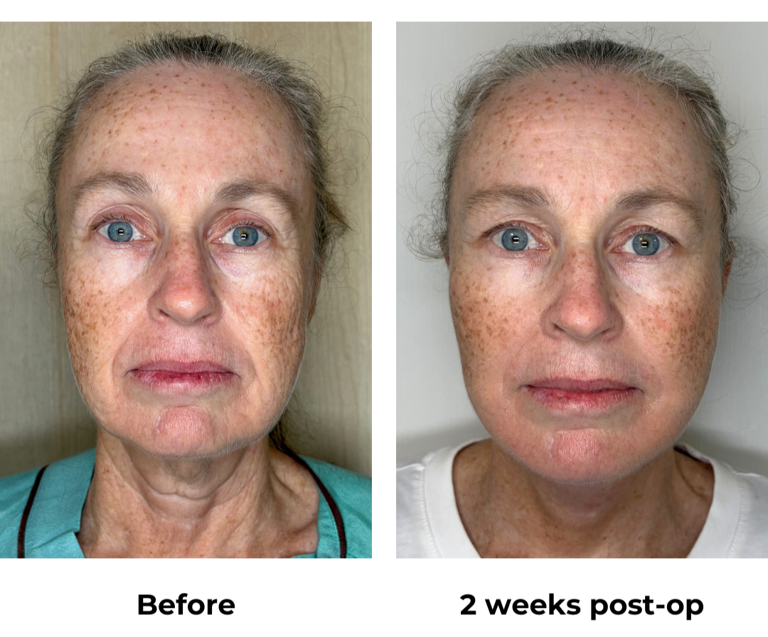 Kylie had FFNL with Dr. Ring  (1)