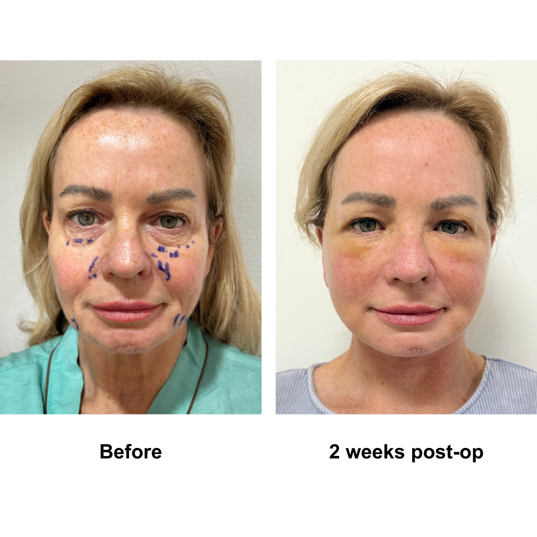 Kym had MFNL + Fat transfer to lower eyes with Dr. Ring (1)