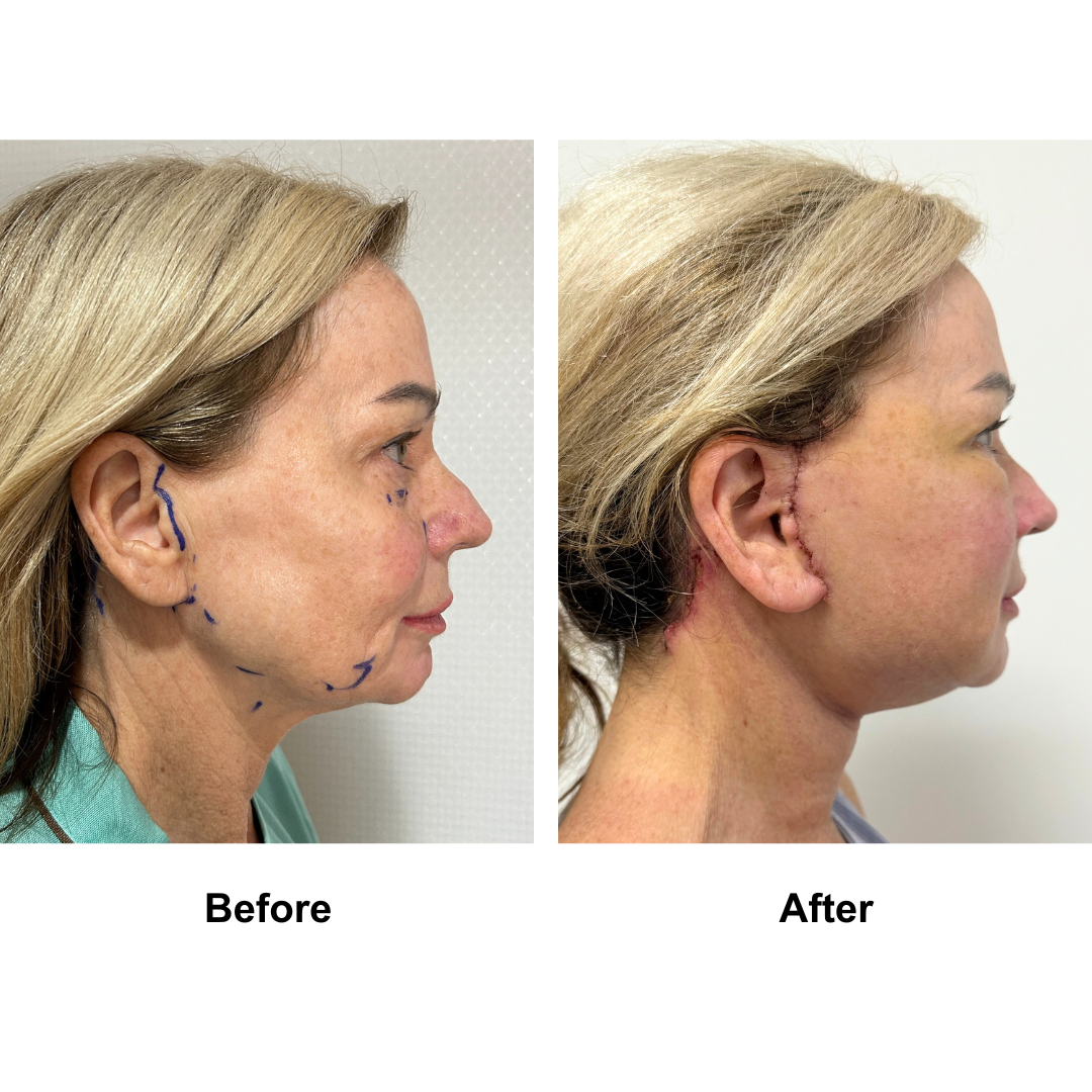 Kym had MFNL + Fat transfer to lower eyes with Dr. Ring (2)