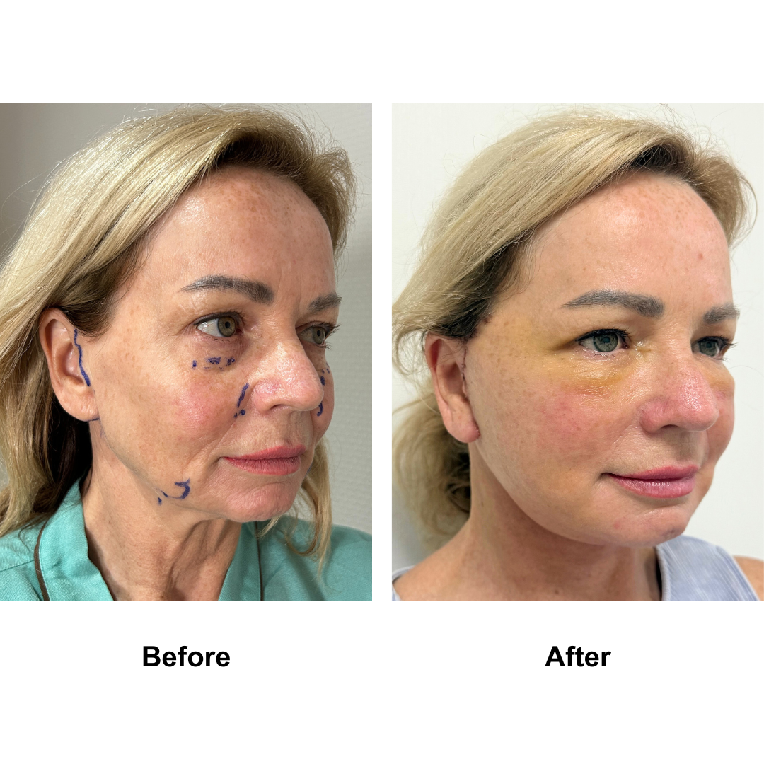 Kym had MFNL + Fat transfer to lower eyes with Dr. Ring (3)