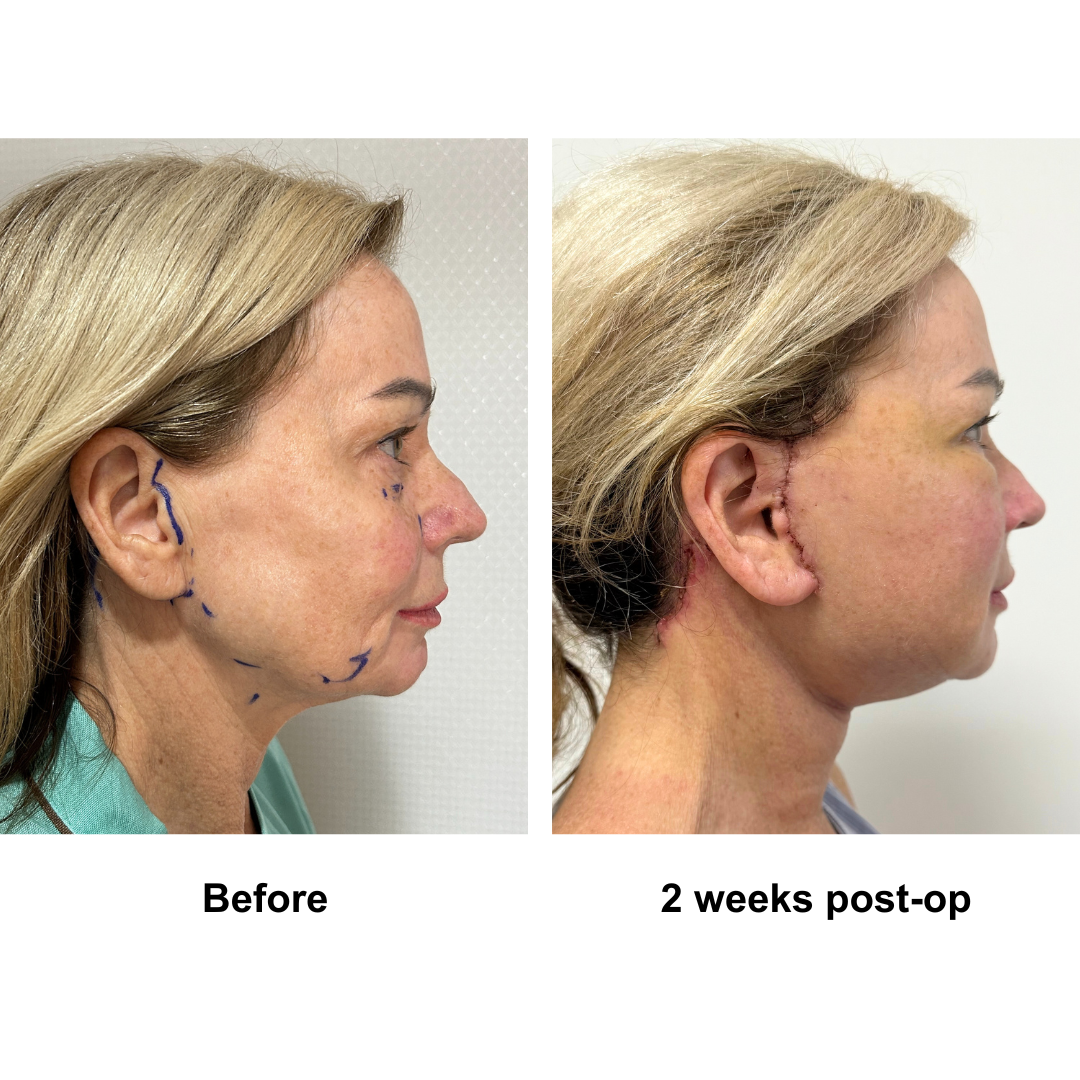 Kym had MFNL + Fat transfer to lower eyes with Dr. Ring (4)