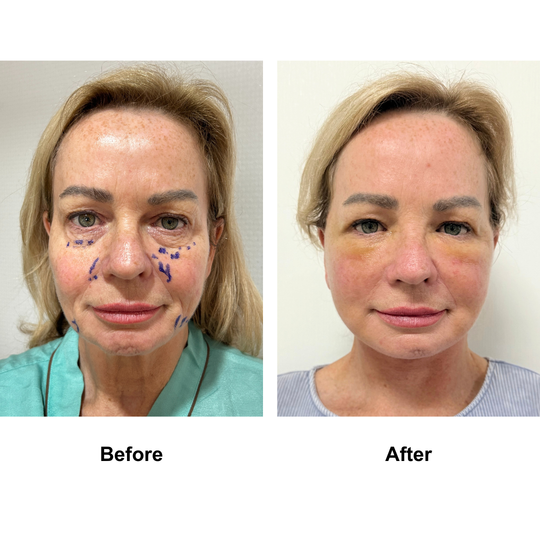 Kym had MFNL + Fat transfer to lower eyes with Dr. Ring